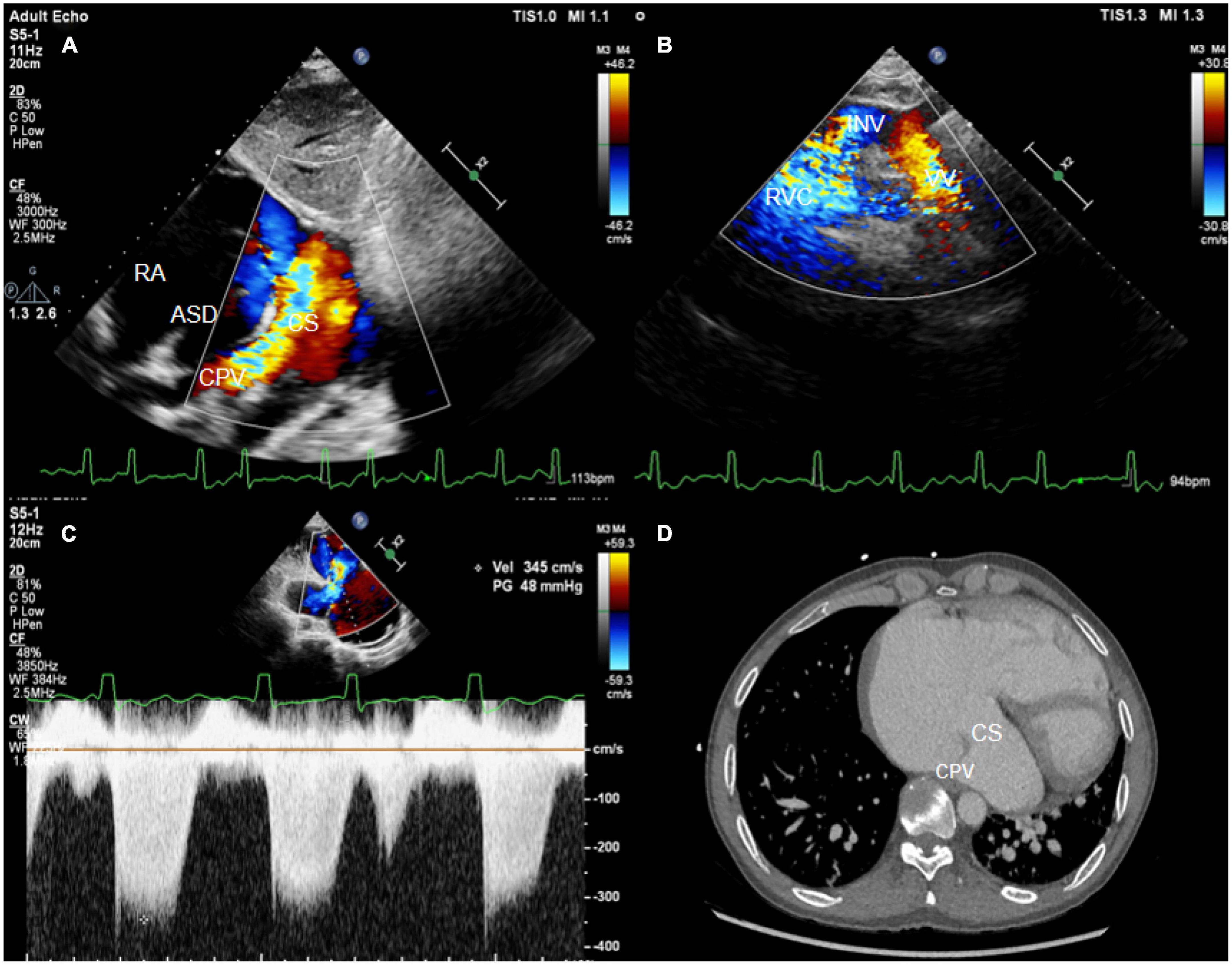 Case report: Thoughts on two cases of total anomalous pulmonary venous connection complicated with pulmonary artery hypertension